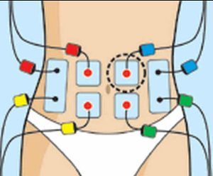 Colocación de electrodos o parches para electroestimulacion y dolores de regla o dolores de menstruación