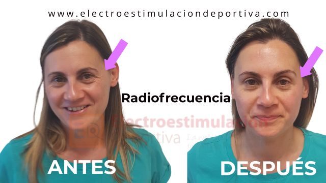 Radiofrecuencia antes y después